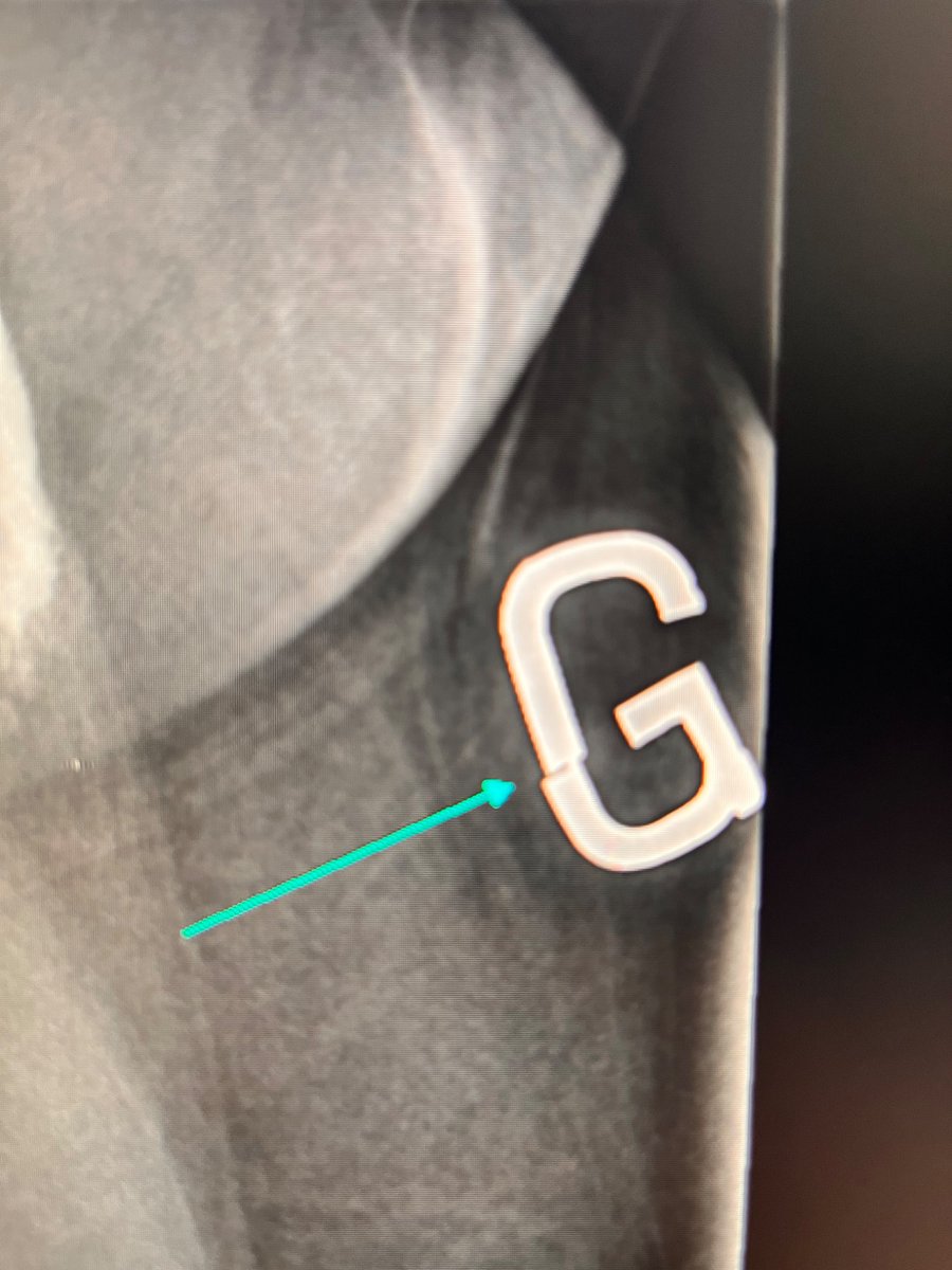 Minimally displaced X-ray marker fracture. What would you do? #orthotwitter