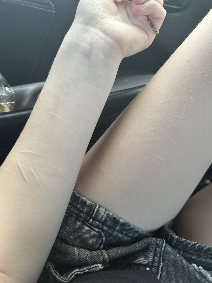 cxxted's tweet photo. I love my scars🫶 (ignore the fact I’m fat) https://t.co/hCl3pXMI8R