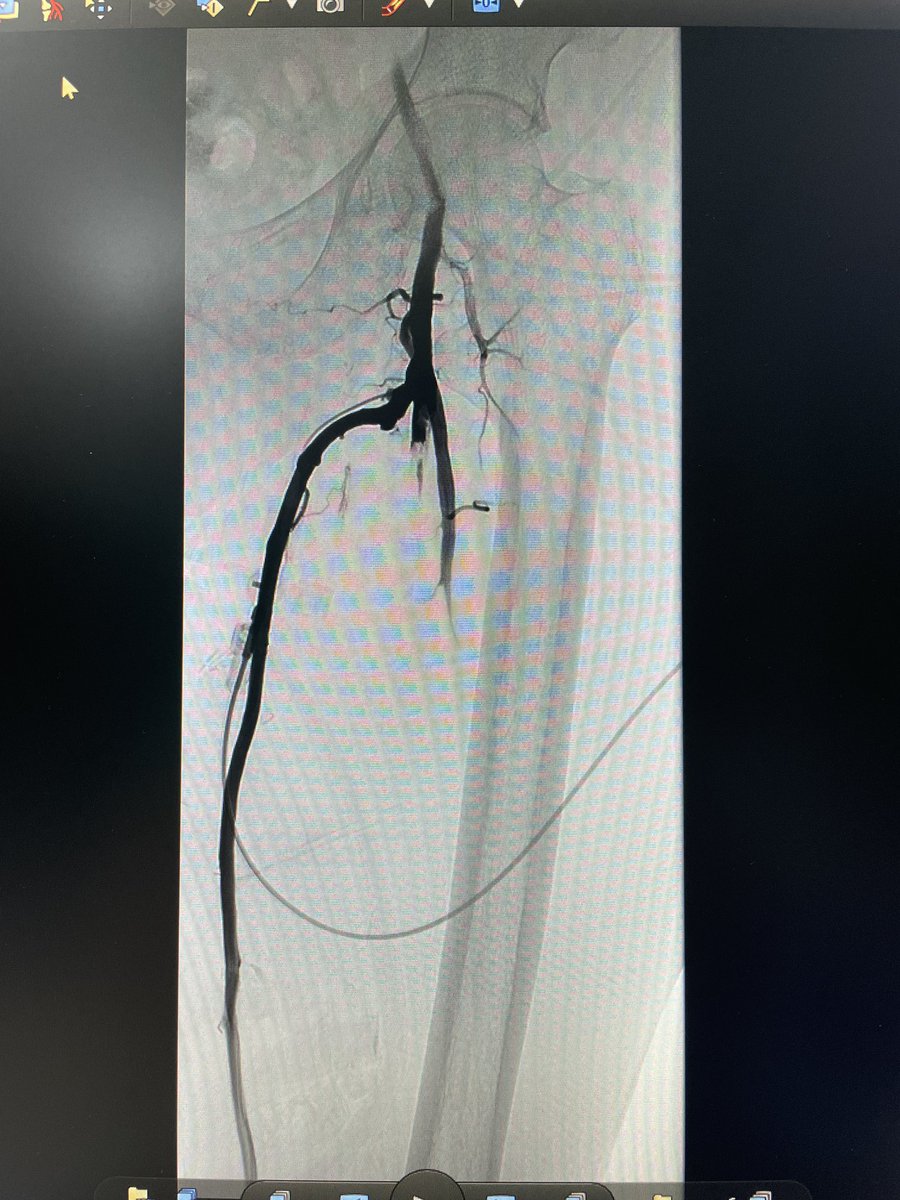 yuejianing's tweet photo. after in-situ distal bypass, for those residual small tributaries in the final angio, do you consider it necessary to ligate them all? #CLTIFighter #limbsalvage @jmills1955 @ReneLizola https://t.co/chwWKy5vud