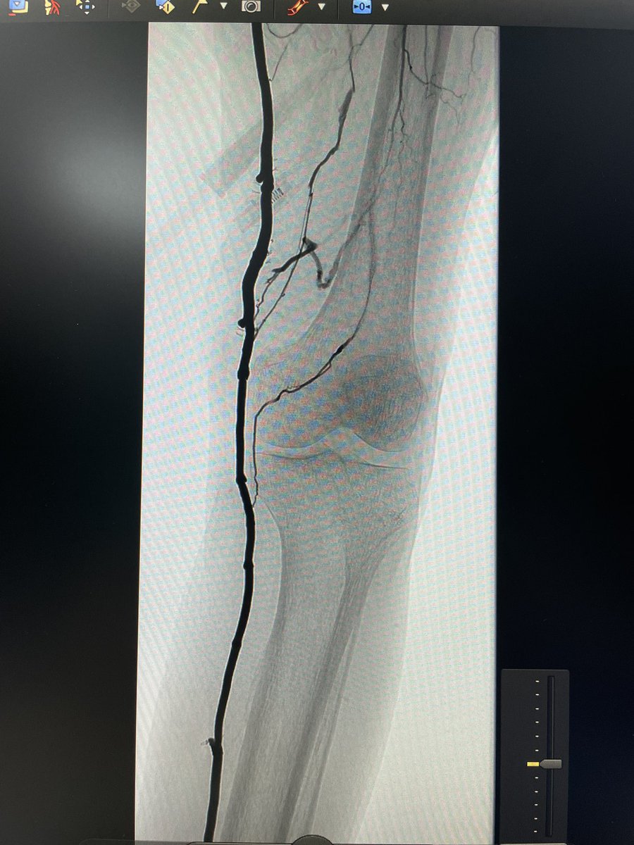 yuejianing's tweet photo. after in-situ distal bypass, for those residual small tributaries in the final angio, do you consider it necessary to ligate them all? #CLTIFighter #limbsalvage @jmills1955 @ReneLizola https://t.co/chwWKy5vud