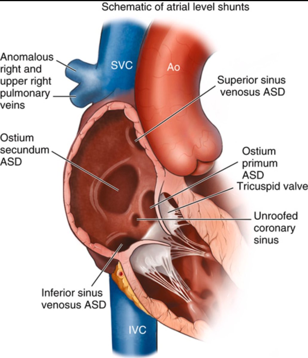 Ostium secundum with a secure rim and Significant shunt= Device Closure
