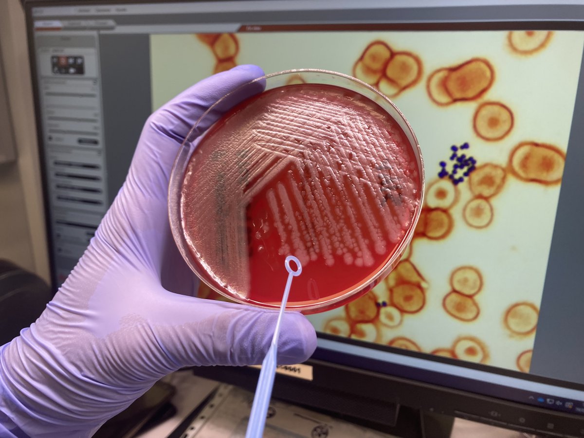 Hospital del Mar (@hospitaldelmar) on Twitter photo Assagen un nou abordatge terapèutic contra un dels #bacteris resistents als #antibiòtics més habitual
Analitza la capacitat de l'apotransferrina per negar-li el #ferro que necessita
Estudi liderat per la Dra. <a href="/MilaMontero7/">Mila Montero</a> a <a href="/IJAA_ISAC/">International Journal of Antimicrobial Agents</a>
hospitaldelmar.cat/ca/noticies/vi… Assagen un nou abordatge terapèutic contra un dels #bacteris resistents als #antibiòtics més habitual
Analitza la capacitat de l'apotransferrina per negar-li el #ferro que necessita
Estudi liderat per la Dra. <a href="/MilaMontero7/">Mila Montero</a> a <a href="/IJAA_ISAC/">International Journal of Antimicrobial Agents</a>
hospitaldelmar.cat/ca/noticies/vi…