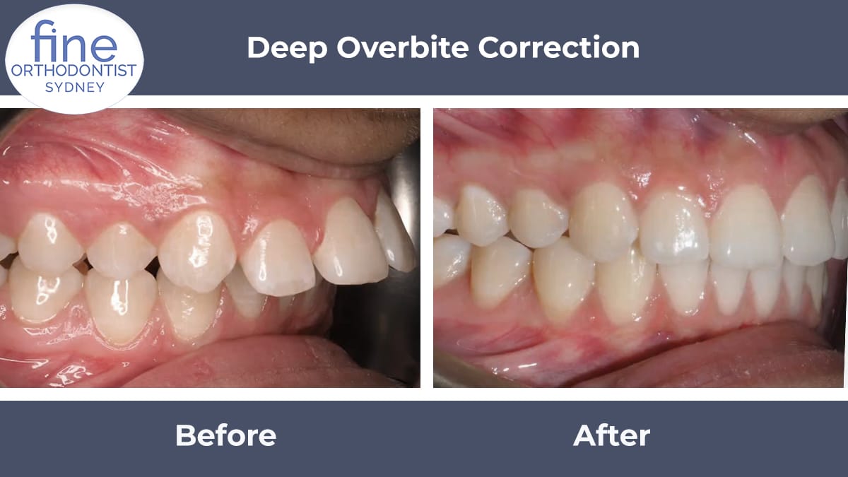 martin__fine's tweet image. They may sometimes look minor, but can quietly cause:
– Severe lower incisor wear
– Palatal trauma
– Restorative complexity
Aesthetic issues aside, function matters.
More on why it’s worth catching early:
🔗 fineorthodontics.com.au/blog/overbite-…
#DeepBite #PreventativeOrthodontics
Notes: Class…