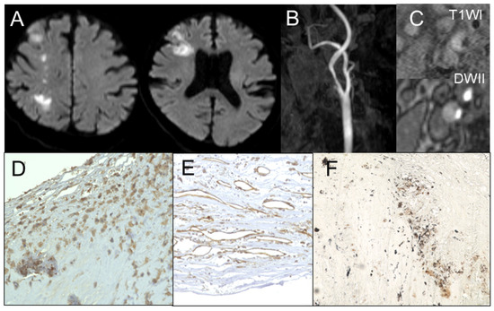 JCM_MDPI's tweet photo. #mdpijcm
#Feature_Paper
Effect of Monosodium Urate Crystal Deposition on #Atherosclerotic Carotid Plaques
by Daina Kashiwazaki🙌
👉https://t.co/N9W8QSJRUA
@MediPharma_MDPI https://t.co/qL2Jk8oTZ9