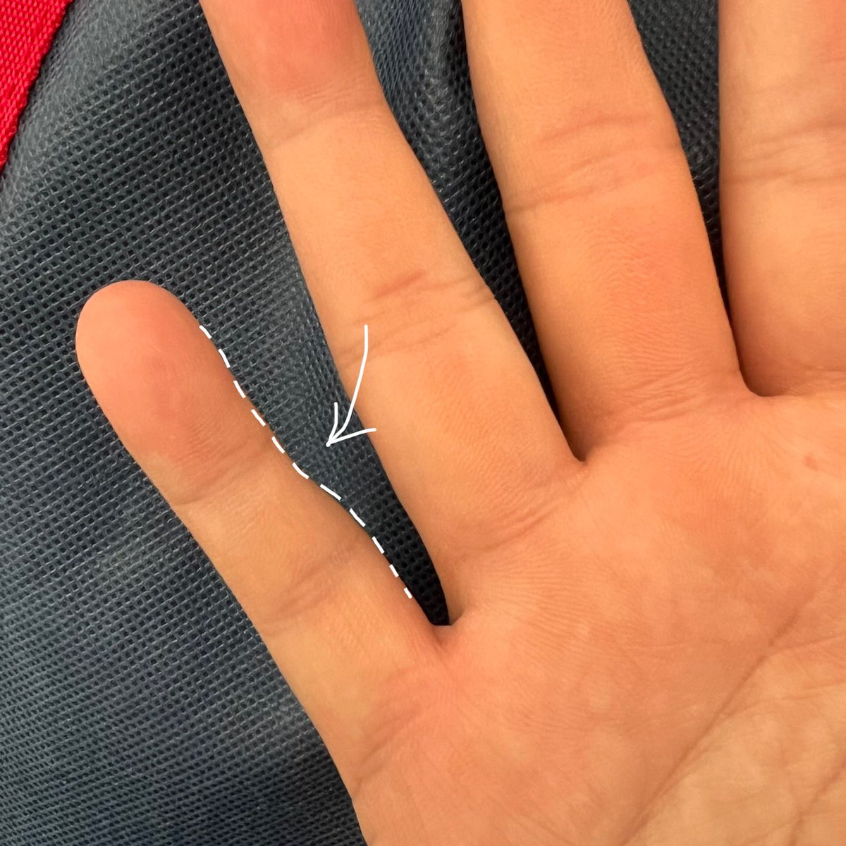 DIGITALYCHEE's tweet image. 今天突然发现，右手小拇指的关节位置变形有点严重。

是不是📱手机拿多了 😭😭