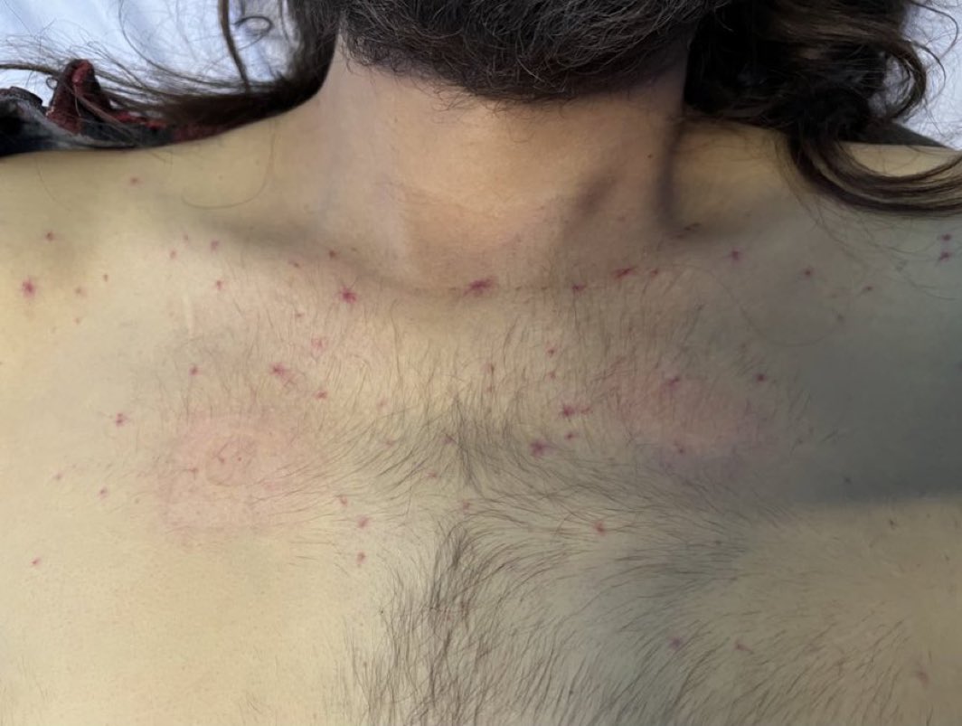 Can you spot the diagnosis in this patient with a fever?