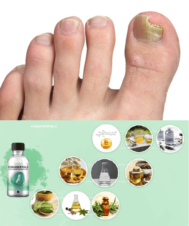 NaturalHealthON's tweet photo. Kerassentials is a doctor-formulated, oil-based supplement designed to combat toenail and skin fungal infections while promoting nail and skin health. 
Learn More - https://t.co/TKd5r1TS4V
#Kerassentials #ToenailFungus #NailHealth #NaturalRemedy #FungalInfections #AntifungalOils https://t.co/18UUfBfMCZ