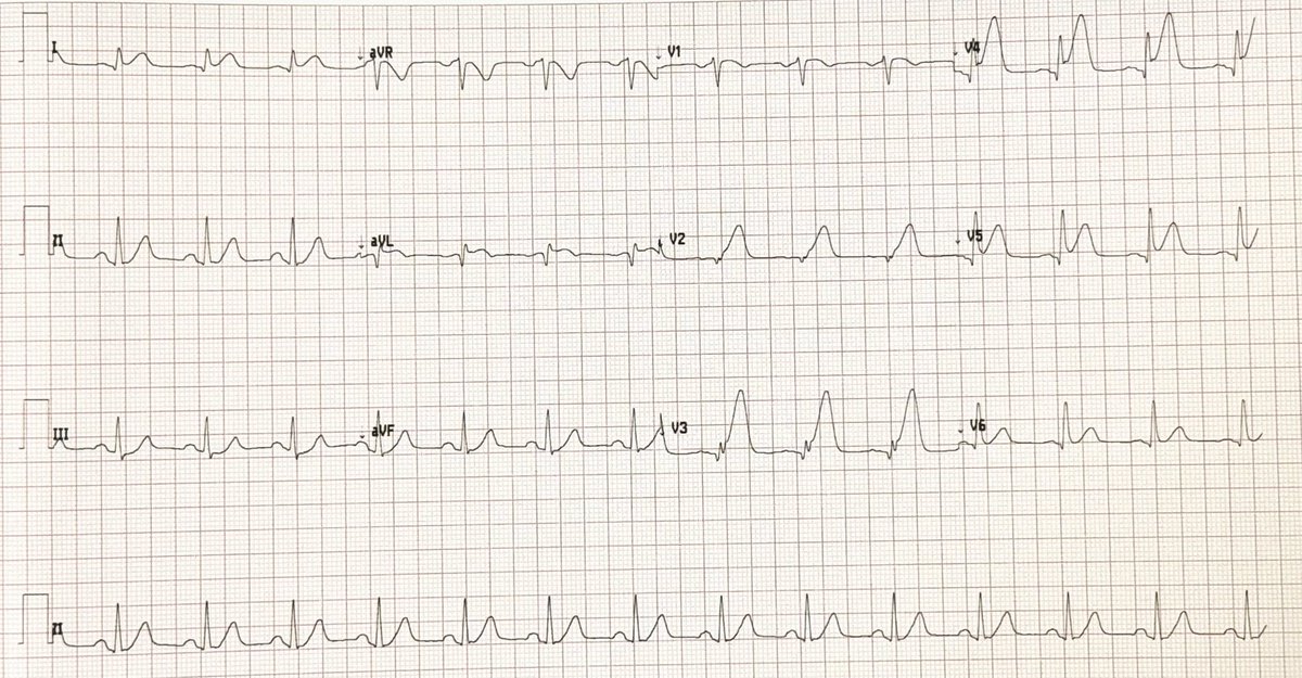 60 years old patient came to the ER with severe chest pain since 4 hours, what do you see?