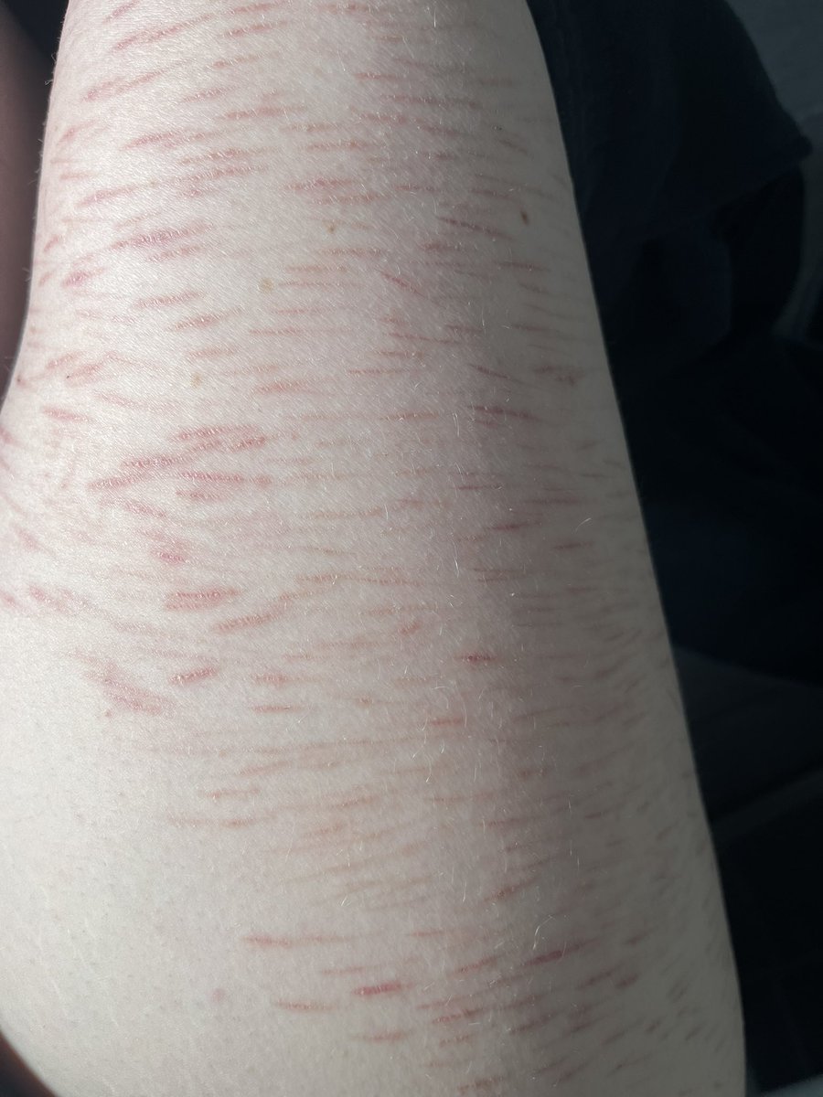 Literally pissing as im takimg these pictures but scar checkkkk