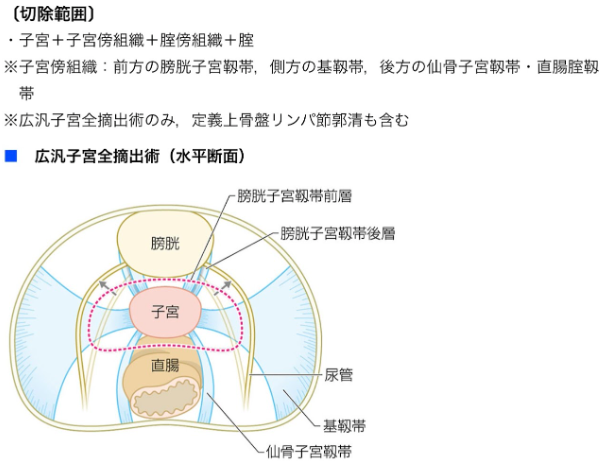 あなたは覚えてる？？-産婦人科編-/ 【広汎子宮全摘出術（水平断面
