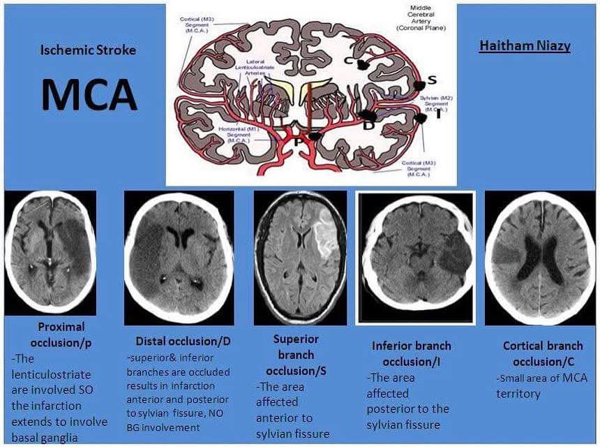 EhabRef48805806's tweet photo. cerebral ischemia
MCA territory https://t.co/sq828pInNo