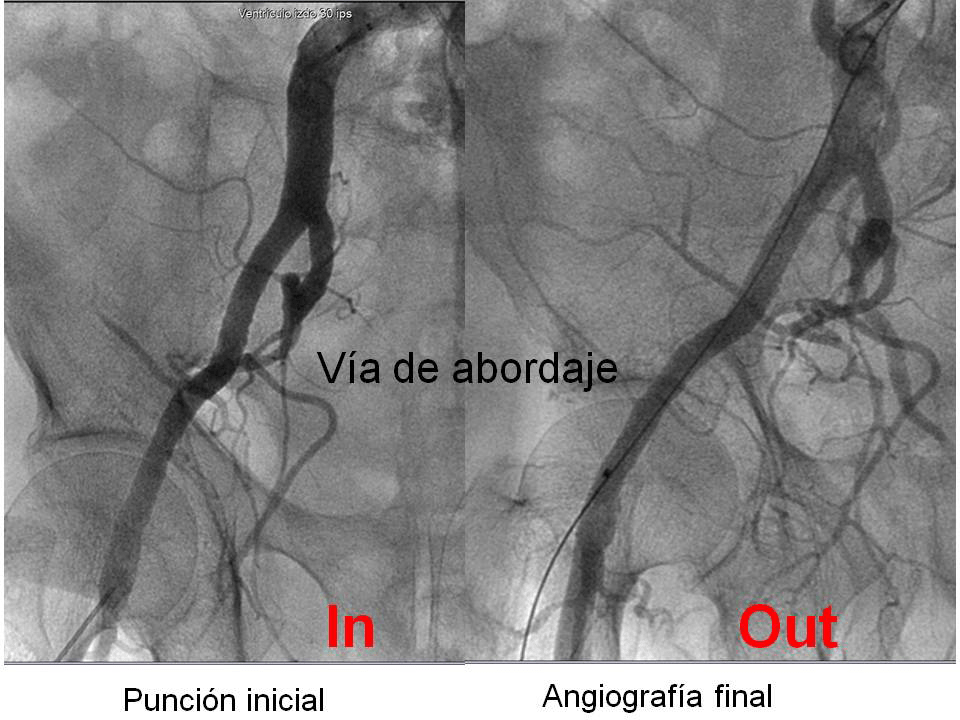 grupocorpal's tweet photo. 🏥 #casoclinico
🩺Implante de válvula aórtica en paciente con Estenosis Aórtica severa.
🫀El paciente evolucionó favorablemente y fue dado de alta a los 3 días de su ingreso.
#TAVI #implante #estenosis #cardiologia #CardioX
🌐 https://t.co/kRvWhuqIc3 https://t.co/Dr3Ueb2axn