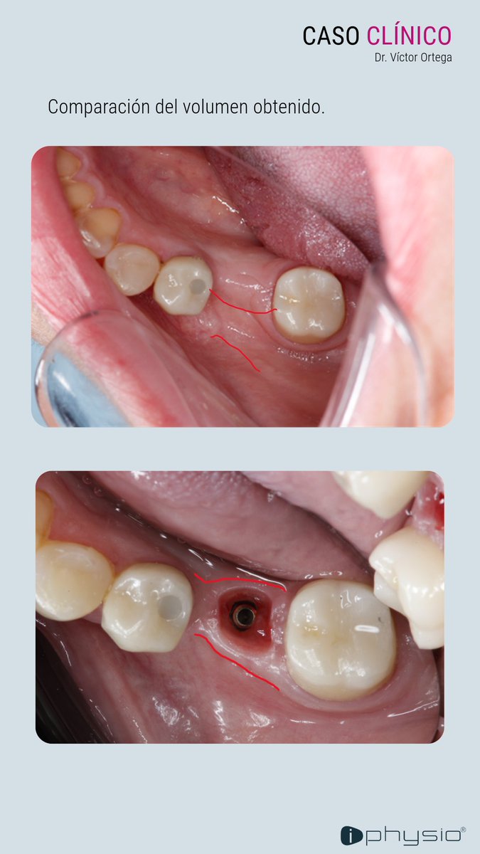 🔎CASO CLÍNICO

Descubre las imágenes clínicas del Dr Víctor Ortega sobre el protocolo iPhysio®.

Para otros casos clínicos, consulta AQUÍ 👇 iphysio.dental/es/casos_clini…

Simple. Safe. Accesible😊

#lyraetk #etkimplant #implantology #iphysiodental #implantesdentales #casosclinicos