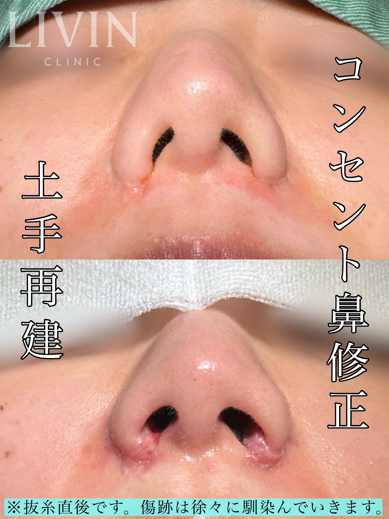 外鼻の再建 【裁断済み】