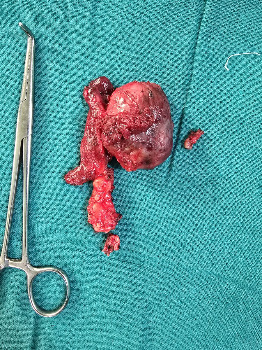 Sanjay k Yadav MCh, FACS, FSSO tweet media