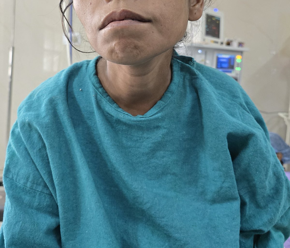 Sanjay k Yadav MCh, FACS, FSSO tweet media