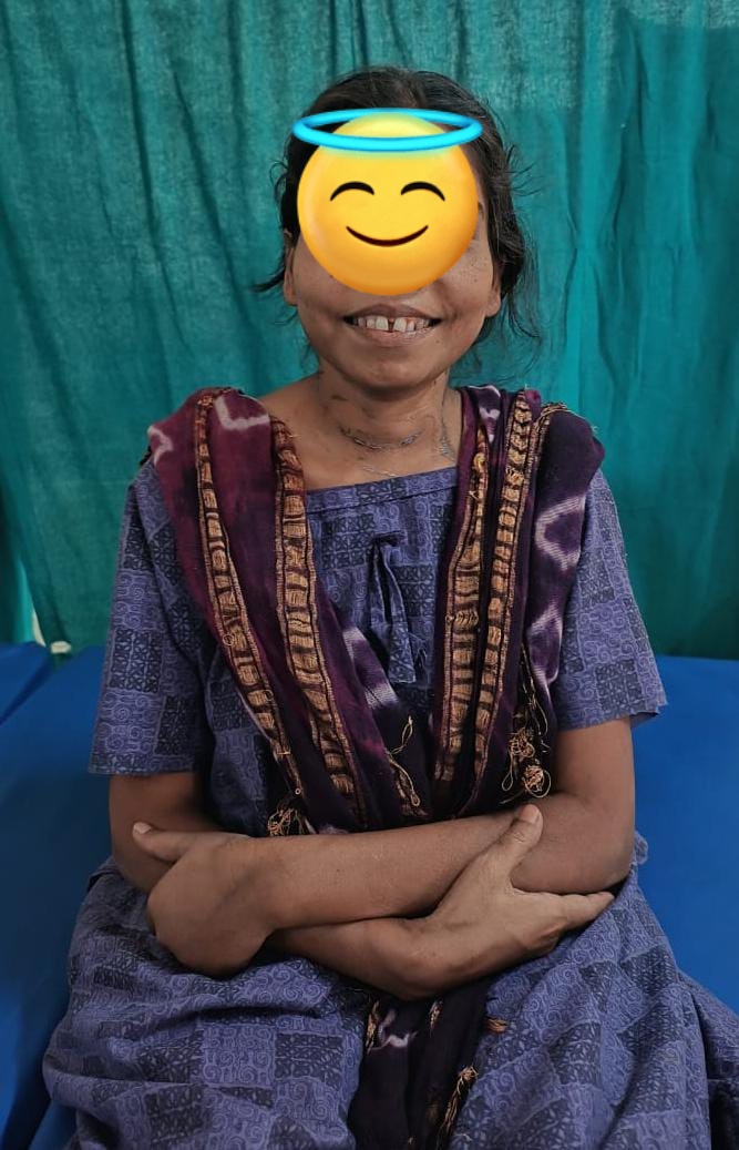 Two rare cases of severe PHPT — one with acute pancreatitis, the other with multiple fractures. 

Welcome to the other side of Endocrine Surgery.

#GlobalSurgery #EndocrineSurgery #PHPT #MedTwitter 
When was the last time when you saw such severe PHPT? 
<a href="/AmCollSurgeons/">American College of Surgeons</a> <a href="/TheAAES/">American Association of Endocrine Surgeons</a>