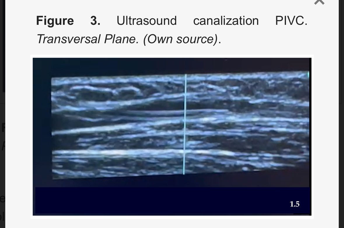 Orgullosa de nuestra doctoranda con su primer artículo de tesis mdpi.com/2039-4403/15/5… Comparison of Traditional and Ultrasound-Guided Techniques for Vascular Access in Patients with Difficult Venous Access in Emergency Departments: Randomized Clinical Trial Protocol