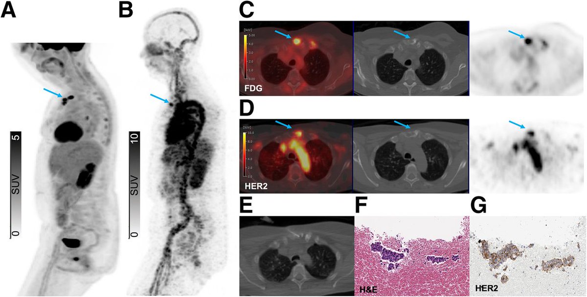 JNM (@journalofnucmed) on Twitter photo HER2 PET imaging can detect HER2-low and HER2-positive lesions in metastatic #BreastCancer patients, allowing for better select patients for T-DXd and other HER2-targeted therapies. ow.ly/utFq50VSPz4
#NuclearMedicine <a href="/LewisLabMSKCC/">Jason Lewis Radiochem MSK</a> <a href="/amauguen/">Audrey Mauguen</a> <a href="/JoshDragoMD/">Josh Drago</a> HER2 PET imaging can detect HER2-low and HER2-positive lesions in metastatic #BreastCancer patients, allowing for better select patients for T-DXd and other HER2-targeted therapies. ow.ly/utFq50VSPz4
#NuclearMedicine <a href="/LewisLabMSKCC/">Jason Lewis Radiochem MSK</a> <a href="/amauguen/">Audrey Mauguen</a> <a href="/JoshDragoMD/">Josh Drago</a>