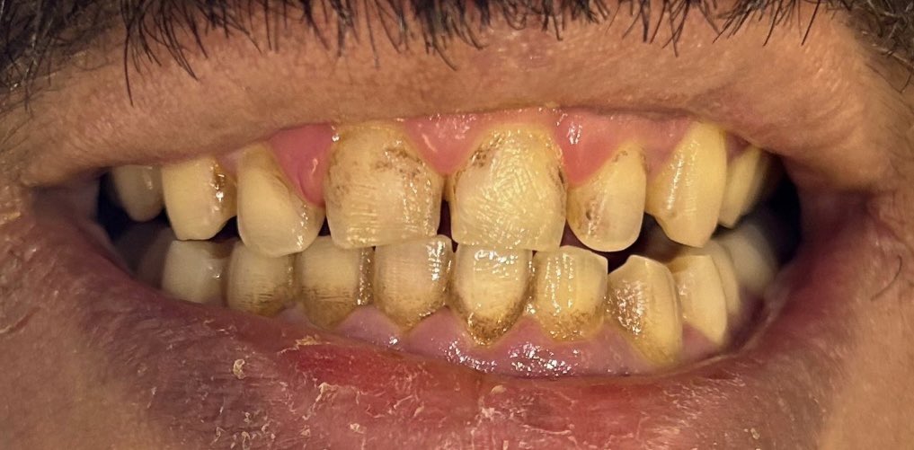 One session, noticeable difference 🫧🦷