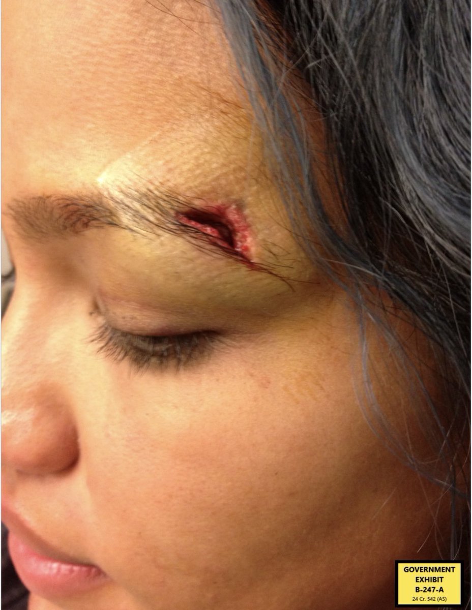 WeOutHereNews's tweet photo. 🚨 PROSECUTORS upload evidence that they've shown to the jury including these photos

These photos depict injuries to Cassie's eyebrow area after being struck by Diddy

Image on the left is soon after the injury. Image on the right is a full week after the injury https://t.co/PdrYpbqeSb