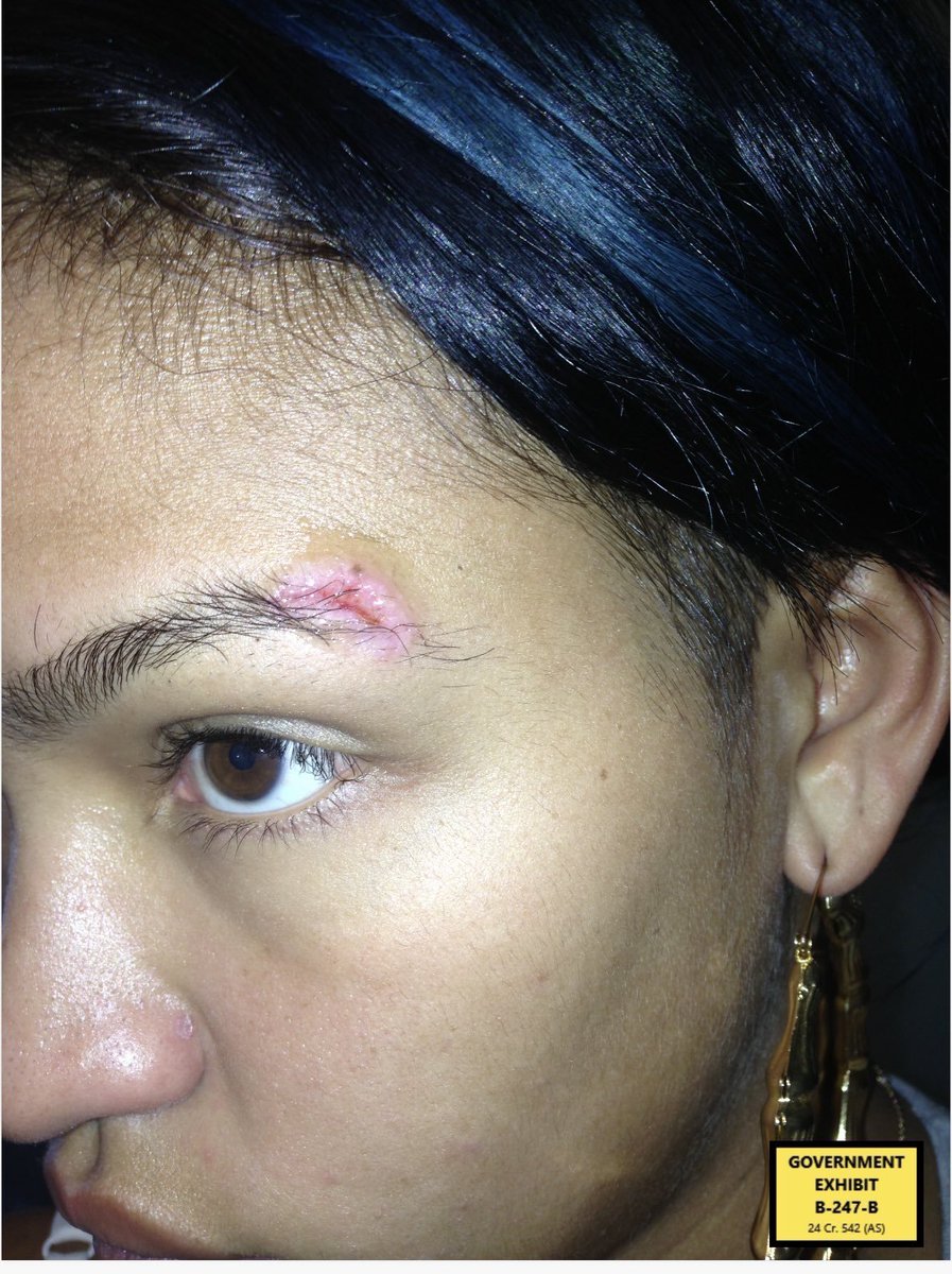 WeOutHereNews's tweet photo. 🚨 PROSECUTORS upload evidence that they've shown to the jury including these photos

These photos depict injuries to Cassie's eyebrow area after being struck by Diddy

Image on the left is soon after the injury. Image on the right is a full week after the injury https://t.co/PdrYpbqeSb