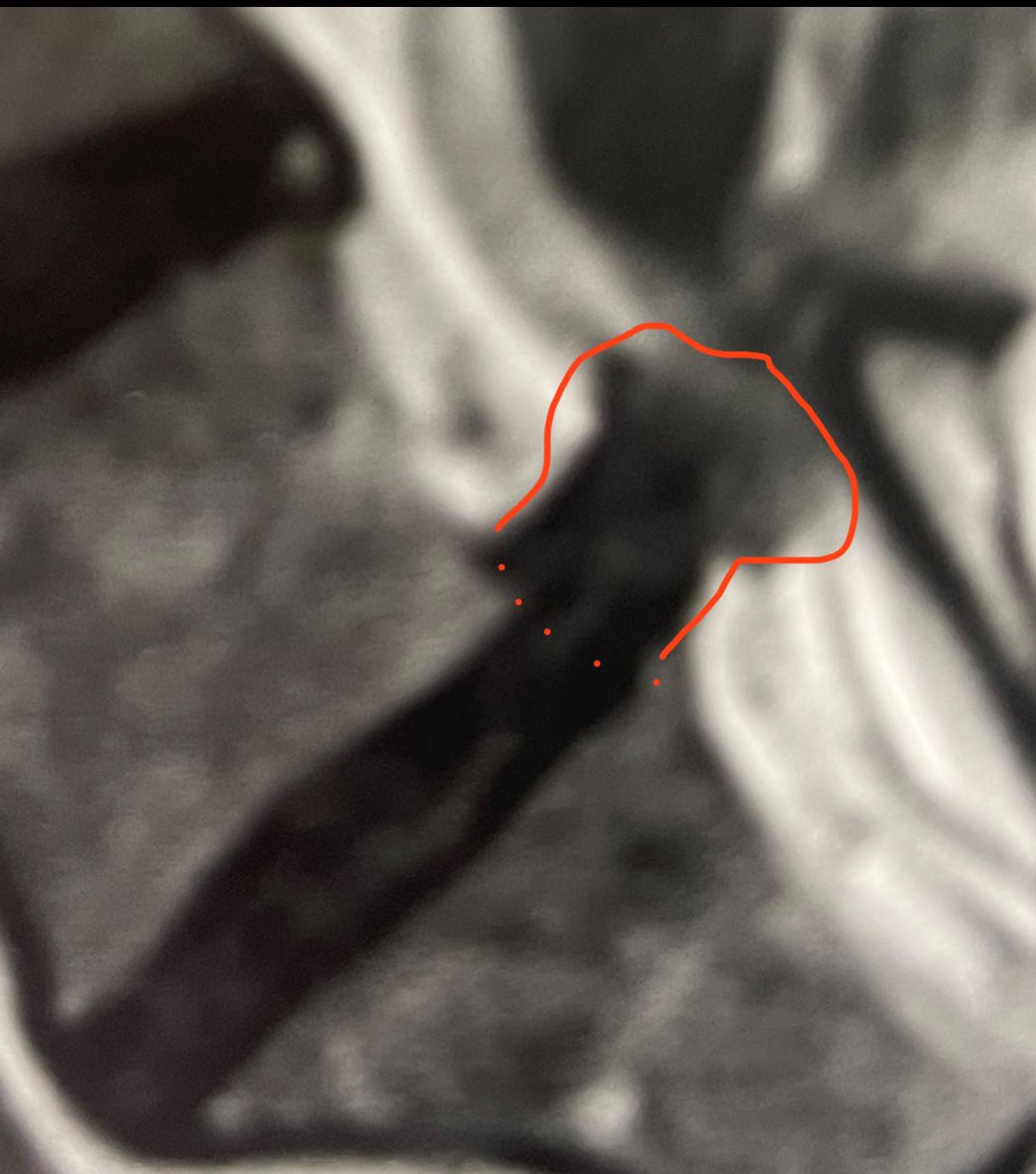 Hécatombe osteo ce matin à l’🏥

Patient 1: opéré d une hernie, qui est apparue dans les suites d une manip lors d’un bilan ostéo … allait parfaitement bien avant . Manip= sciatique déficitaire, fragment migré/exclu +++= chirurgie (cliché👇)

Patient 2: Mineur🚩, manipulé 3