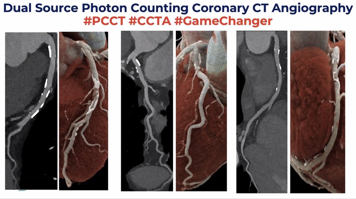 Rutgers NJMS Division of Cardiology (@rutgerscardio) on Twitter photo Incredible Dept. of Med. Grand Rounds by <a href="/RonBlankstein/">Ron Blankstein</a> on #CCTA from Detection to #prevention
👉key takeaways:
🖼️ show patients their images
🔍plaque ⤴️ intensify prevention
🚨Coming soon to Newark 🚨#PCCT #GameChanger
<a href="/Rutgers_card/">Rutgers NJMS Cardiology Fellowship</a> <a href="/RutgersCVI/">Rutgers NJMS CV Imaging</a> @ACCFIT #YesCT #CVImaging <a href="/NJACC/">NJ Chapter of ACC</a> Incredible Dept. of Med. Grand Rounds by <a href="/RonBlankstein/">Ron Blankstein</a> on #CCTA from Detection to #prevention
👉key takeaways:
🖼️ show patients their images
🔍plaque ⤴️ intensify prevention
🚨Coming soon to Newark 🚨#PCCT #GameChanger
<a href="/Rutgers_card/">Rutgers NJMS Cardiology Fellowship</a> <a href="/RutgersCVI/">Rutgers NJMS CV Imaging</a> @ACCFIT #YesCT #CVImaging <a href="/NJACC/">NJ Chapter of ACC</a>