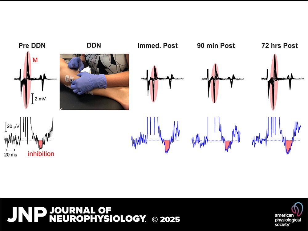 JNP (@jneurophysiol) on Twitter photo 🎙️New Podcast Alert! Join coauthor Gretchen Seif as she unpacks their study on deep dry needling's impact on spinal reflexes. Discover key findings, muscle mechanics, and clinical implications that could transform practice!
🎧ow.ly/x43m50VVEGU
<a href="/gretchenseif/">Gretchen Seif</a> #Plantarflexor 🎙️New Podcast Alert! Join coauthor Gretchen Seif as she unpacks their study on deep dry needling's impact on spinal reflexes. Discover key findings, muscle mechanics, and clinical implications that could transform practice!
🎧ow.ly/x43m50VVEGU
<a href="/gretchenseif/">Gretchen Seif</a> #Plantarflexor