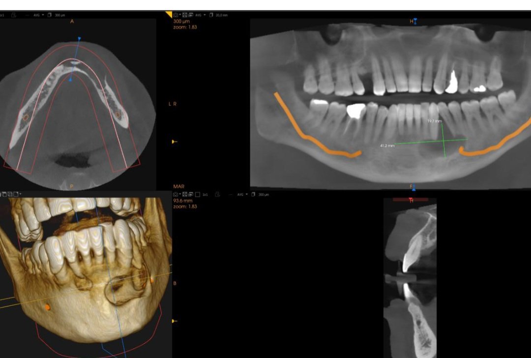drdevito's tweet photo. Osteolytic lesion of the mandible of a 56yo man. Clinica diagnosis: Ameloblastoma (unicystic). What's your opinion @sakhurram and @merva_st ? https://t.co/9PPLF3jNRK