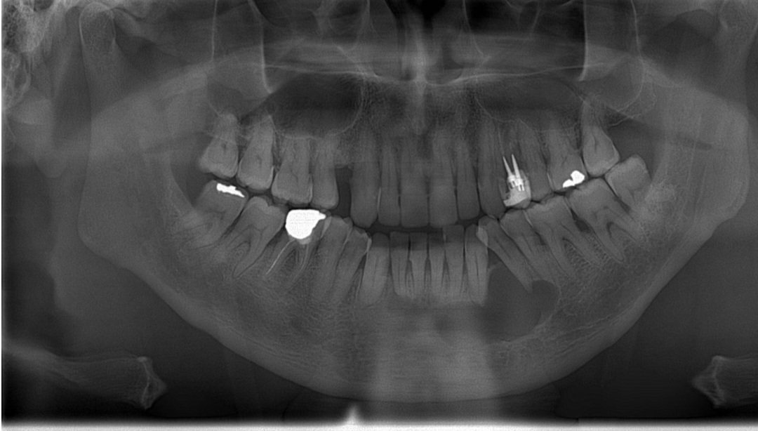 drdevito's tweet photo. Osteolytic lesion of the mandible of a 56yo man. Clinica diagnosis: Ameloblastoma (unicystic). What's your opinion @sakhurram and @merva_st ? https://t.co/9PPLF3jNRK