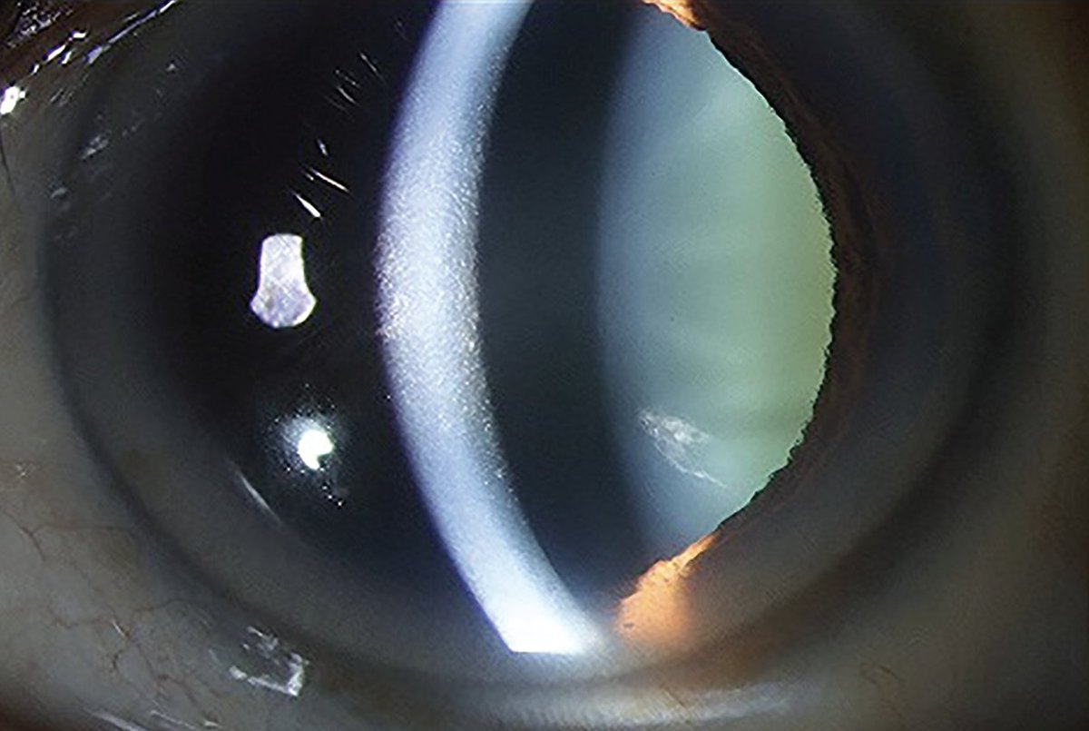 RevOphth's tweet image. Find surgical tips for DMEK to enhance efficiency and improve outcomes in the May feature, "Current Tips and Tricks for Maximizing DMEK Outcomes." 

Read now: reviewofophthalmology.com/article/curren… 📖
#ophthalmology #ophthalmologist #eyedoctor #DMEK #cornea #cornealsurgery #fuchsdystrophy