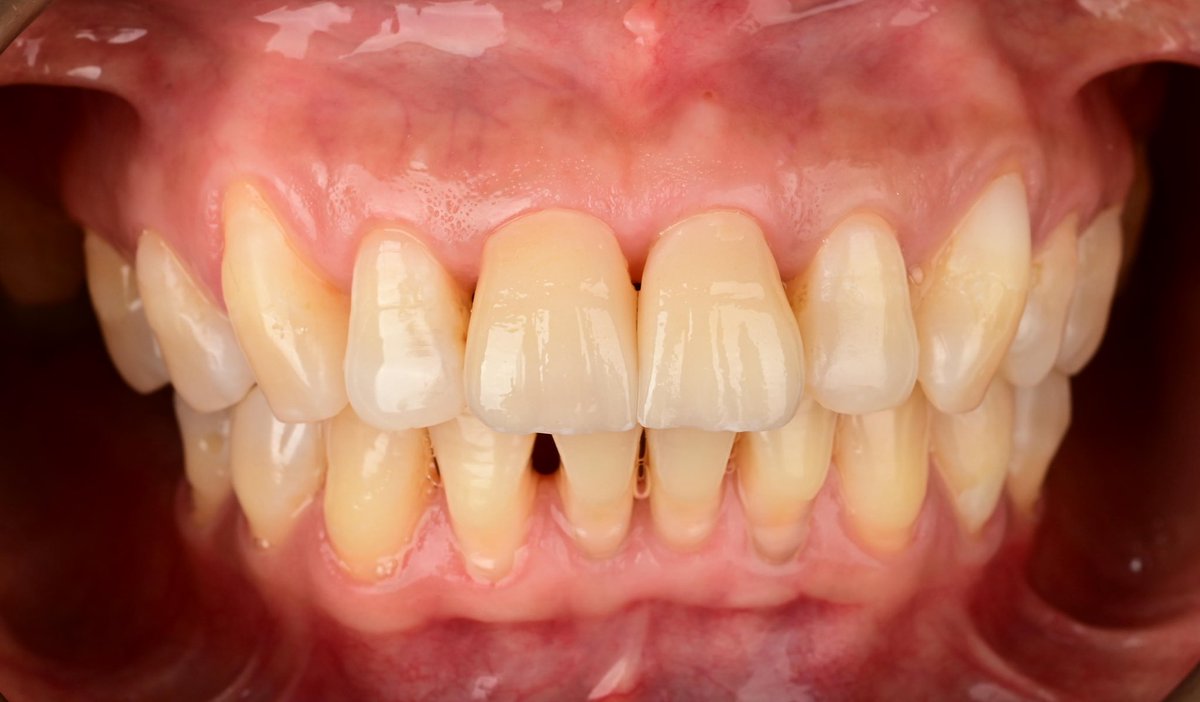 Thrilled to share my long journey 🤍
This is the last comprehensive case as an undergrad looking forward to share cases as postgrad 🤍
الحمدلله على التمام 🤍