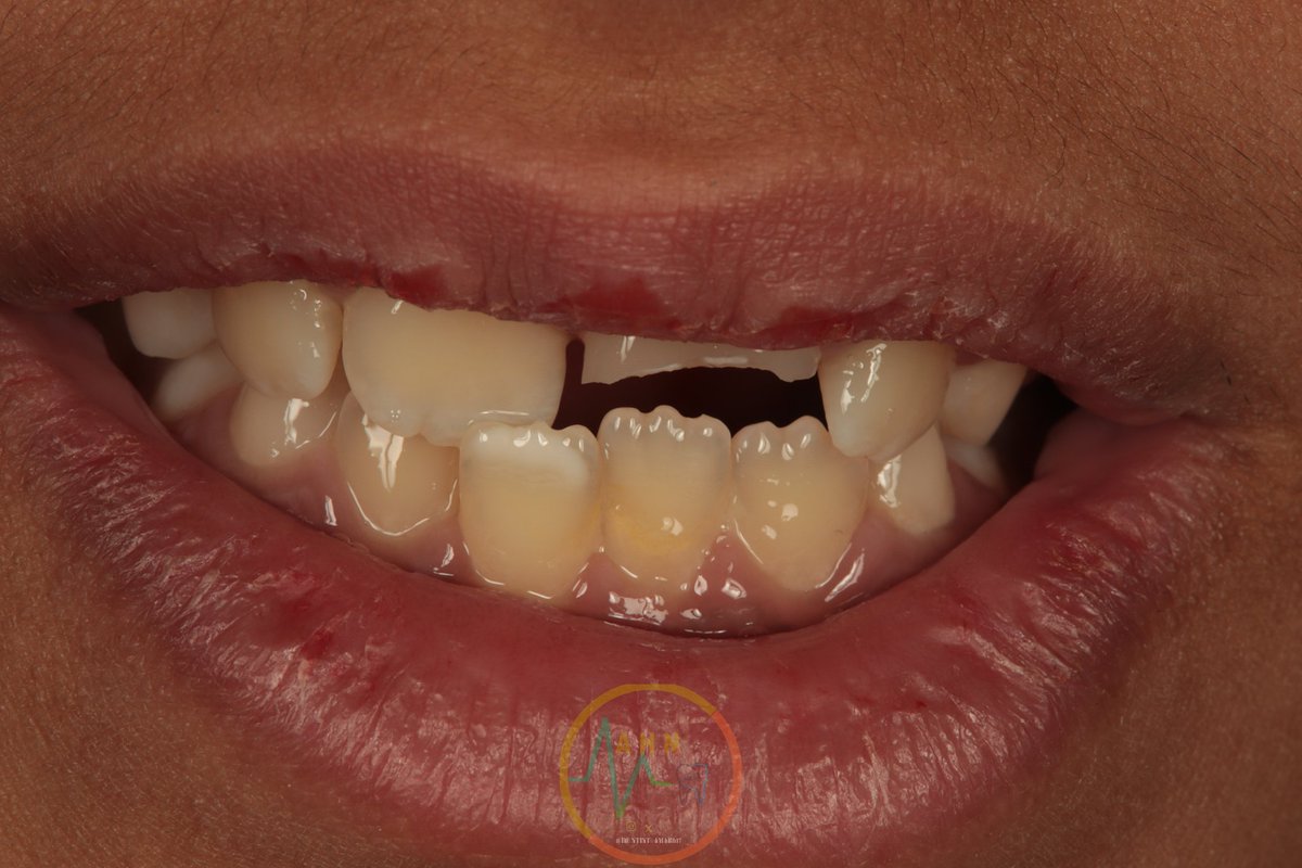 dentist_amar617's tweet image. سقط على سنه فإنكسر وحشوة تجميلة الحل
Direct  composite  veneer  for uper left central incisor  fractured due to falling of
Tooth surfaces beveled+ sandplasted
Built  with multilayer technique 
#saveatooth  #esthetics  #composite_veneer 
النتيجه النهائية  فب التغريدة التالية