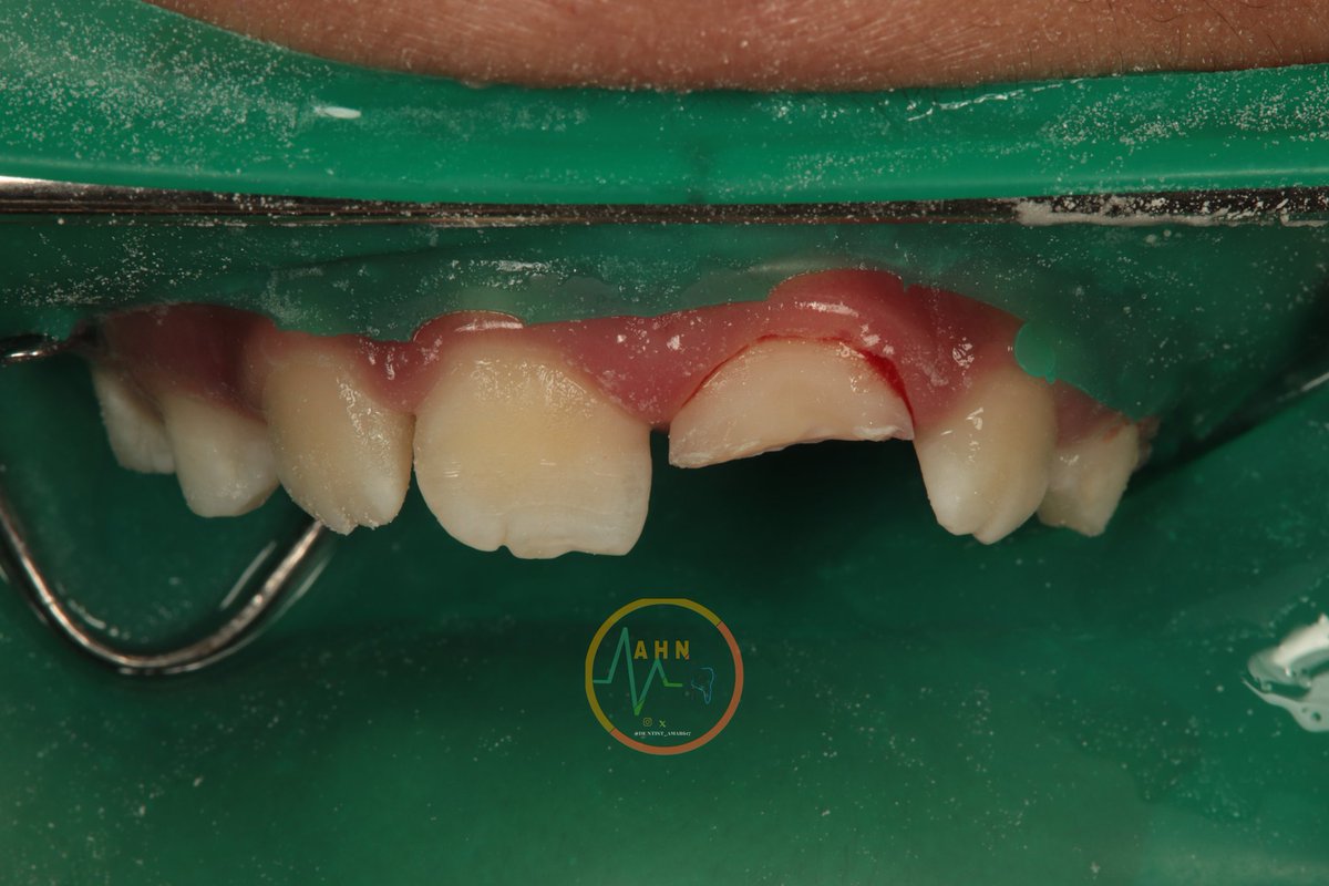 dentist_amar617's tweet image. سقط على سنه فإنكسر وحشوة تجميلة الحل
Direct  composite  veneer  for uper left central incisor  fractured due to falling of
Tooth surfaces beveled+ sandplasted
Built  with multilayer technique 
#saveatooth  #esthetics  #composite_veneer 
النتيجه النهائية  فب التغريدة التالية
