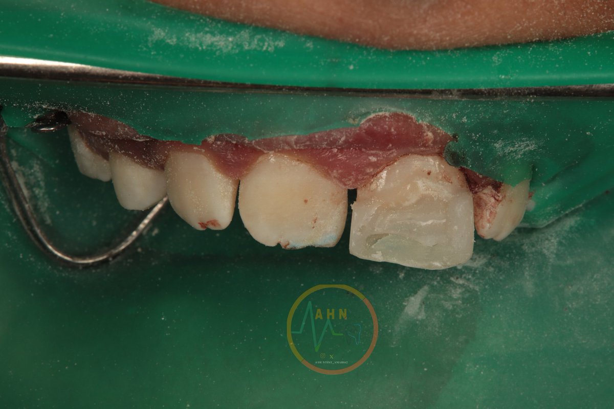 dentist_amar617's tweet image. سقط على سنه فإنكسر وحشوة تجميلة الحل
Direct  composite  veneer  for uper left central incisor  fractured due to falling of
Tooth surfaces beveled+ sandplasted
Built  with multilayer technique 
#saveatooth  #esthetics  #composite_veneer 
النتيجه النهائية  فب التغريدة التالية