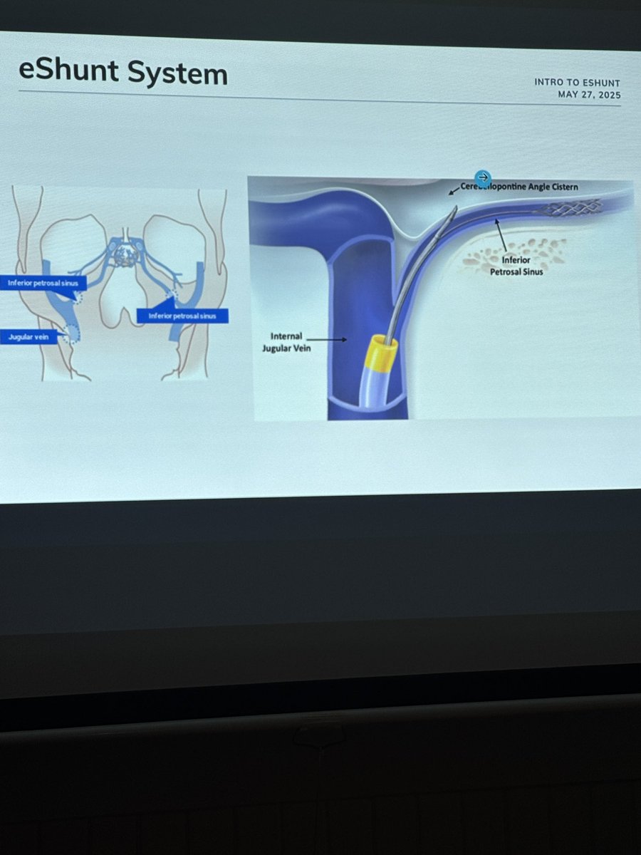 Neurovascular Center @ St. Michael's Hospital (@smhneurovasc) on Twitter photo Exciting things about to come… RCT on e-shunt vs VP shunt for NPH! <a href="/CereVasc/">CereVasc</a> Thanks to <a href="/CharlesMatouk/">charles matouk</a> of <a href="/YNeurosurgery/">Yale Department of Neurosurgery</a> for sharing his experience with the team! <a href="/vitorpereiracan/">Vitor Mendes Pereira</a> <a href="/DanniDiestro/">Dr. DiestroKE</a> <a href="/trmarot/">Tom Marotta</a> Exciting things about to come… RCT on e-shunt vs VP shunt for NPH! <a href="/CereVasc/">CereVasc</a> Thanks to <a href="/CharlesMatouk/">charles matouk</a> of <a href="/YNeurosurgery/">Yale Department of Neurosurgery</a> for sharing his experience with the team! <a href="/vitorpereiracan/">Vitor Mendes Pereira</a> <a href="/DanniDiestro/">Dr. DiestroKE</a> <a href="/trmarot/">Tom Marotta</a>