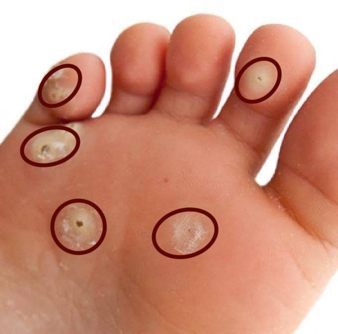 عين السمكة أو مسمار االقدم من المشكلات الشائعة 🚨

الكثير يعانون منها ولا يعرفون حلها
- اذا لقيتها بيدك أو رجلك أنتبه منها 
- لأن هذا عين السمكة وهو معدي وينتقل باللمس
او عن طريق استعمال ادوات المصاب

إليكم كل شيء عن عين السمكة وكيفية التعامل معها :