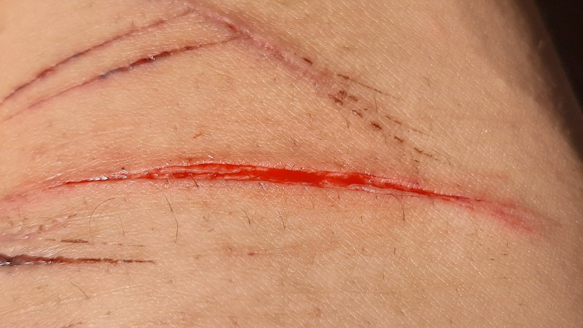 LexKilll's tweet photo. my last cut so far because my dad is going to lock me in my room again and throw my blades away again he thinks that will solve it

#shtwt https://t.co/z49rF6lkM7