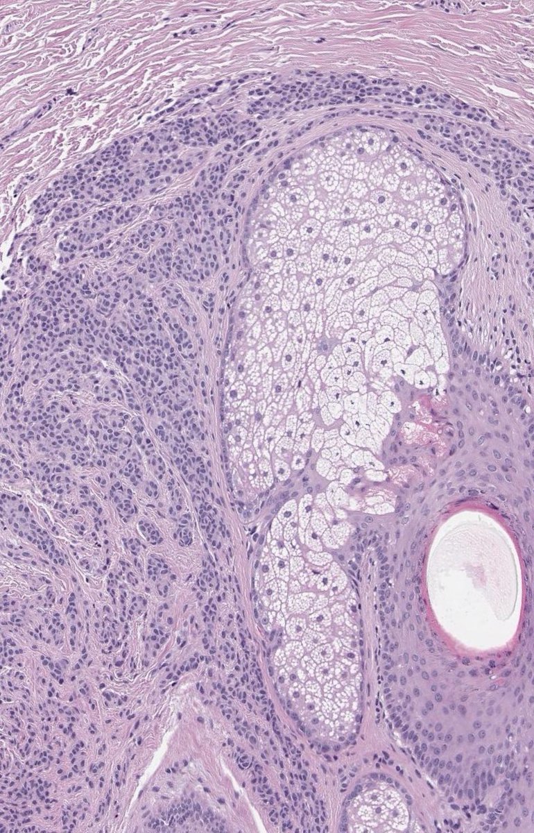 Very revealing peri-adnexal proliferation in a recurrent congenital nevus. 
#dermpath #pathtwitter #dermtwitter