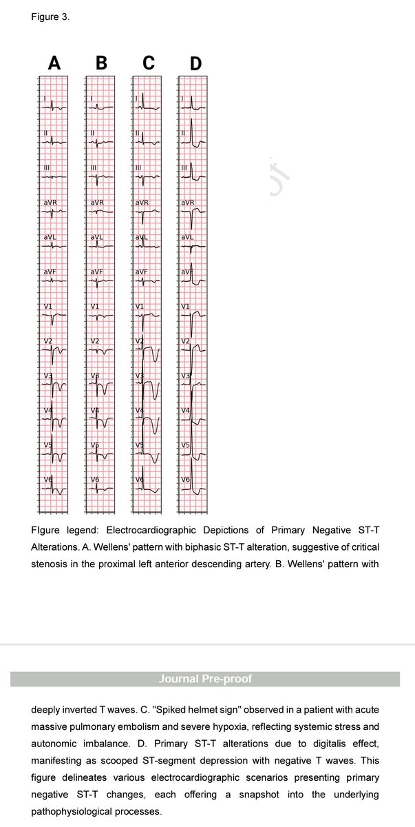 rksanti's tweet photo. 🏥ST segment and T wave abnormalities: A narrative review" (J. Electrocardiol, 2024)
🧵1/¿Quieres interpretar el ECG más allá de la isquemia?
Este artículo es una joya clínica 🫀: una guía práctica y profunda para entender las alteraciones del ST y la onda T más allá del infarto.
2/🔍 ¿Por qué importa este tema?
El ECG es mucho más que buscar isquemia.
👉 El segmento ST y la onda T pueden alterarse por:
• Canales iónicos
• Electrolitos
• Inflamación
• Trastornos genéticos
• Cambios mecánicos del corazón
🧠 ¡La repolarización es un universo!
3/📌 Clasificación clave:
Las alteraciones se dividen en:
🟥 Primarias: afectan directamente al potencial de acción ventricular
🟦 Secundarias: resultado de cambios en la despolarización o geometría cardíaca
🏥Esta distinción lo cambia TODO en la lectura del ECG.
4/🟥 Onda T primaria positiva
🔸Simétrica
🔸Base ancha
🔸Amplitud aumentada
🔸QT alterado
📌Ejemplos:
✅ Infarto agudo (ondas T hiperagudas)
✅ Hiperkalemia (onda T picuda)
✅ Pericarditis
✅ Cardioversión
✅ Canalopatías (LQTS)
5/🔥 ¿Sabías esto del infarto?
La primera manifestación en ECG no es la elevación del ST, sino la onda T hiperaguda:
✔ Alta
✔ Simétrica
✔ Base ancha
Se relaciona con la apertura de canales K+ (IKATP) por hipoxia y acidosis.
📈 ¡Cuidado clínico temprano!
6/⚠️ Hiperkalemia
Provoca ondas T:
✔ Altas
✔ Simétricas
✔ Base ESTRECHA (clave para diferenciarla del infarto)
👀 Visualízalas en V2-V4 y II-III.
A veces, también hay elevación del ST.
🧪 ¡Piensa en K+ cuando veas una T picuda!
7/🟪 Canalopatías
📌 LQTS: QT largo, ↑ Tp-e, ↑ Tp-e/QT
🔹 Tp-e/QT > 0.28 = riesgo de torsades
🔹 Importante en LQTS oculto
📌 Brugada: ST elevado en V1-V2, T negativa simétrica, ↑ dispersión de repolarización
🧬 ECG como herramienta genética
8/🟫 Pericarditis y Miocarditis
ST elevado en muchas derivaciones + T simétrica
🟡 Spodick sign (descenso del segmento PR)
⛔ No sigue territorios coronarios
👁️ ¡No confundas con STEMI!
Miocarditis también puede simular IAM
✔ ST elevado
✔ T negativas
9/🟦 Onda T primaria negativa
📌 Simétrica, profunda
📌 ST descendente
🎯 Ejemplos:
• Síndrome de Wellens
• Miocardiopatía de Takotsubo
• Stroke (ondas T cerebrales)
• Digitalis
• Brugada
• Canalopatías (LQT2, LQT3)
10/💥 Cerebral T wave = un hallazgo de alto impacto
🧠 Subaracnoidea o stroke → descarga adrenérgica → edema miocárdico
✔ Onda T negativa, profunda, simétrica
✔ QT prolongado
✔ Riesgo arrítmico alto en primeras 48h
🫀¡No es un IAM!
11/⚔️ Spiked Helmet Sign
ECG con elevación del ST en forma de casco alemán 🪖
🟣 Inicia ANTES del QRS
🟣 Refleja descarga simpática masiva
🟣 Se ve en estrés crítico: sepsis, hemorragias, TEP
¡Alerta roja! 🚨
12/🟨 Alteraciones secundarias de repolarización
📌 T asimétrica
📌 QT normal
📌 No afectan directamente el potencial de acción
🧩 Causas:
• Bloqueos de rama
• Hipertrofia ventricular
• Cardiopatías estructurales
• Pre-excitación
• Alteración de la contractilidad (TEP, aneurisma)
13/📈 Strain pattern (por HVI)
✔ T negativa, asimétrica
✔ ST descendido
✔ En derivaciones con QRS positivo (V5-V6)
✔ Evoluciona con la hipertrofia
¡Un patrón clásico que NO es isquemia!
14/💡 Tip clínico final:
¿La onda T es simétrica?
✔ Piensa en causas PRIMARIAS: infarto, canalopatía, pericarditis...
¿Es asimétrica?
✔ Piensa en causas SECUNDARIAS: bloqueo, HVI, geometría cardíaca...
🧠 El ECG se interpreta en CONTEXTO.
15/🩻 El ECG es una ventana al potencial de acción
👉 No es solo mirar ST⬆ o T⬇
👉 Es entender por qué se comporta así
Este artículo propone un enfoque sistemático 🧠
🔹 Primaria vs secundaria
🔹 Evaluar morfología
🔹 Integrar clínica + ECG
16/🔚 
La lectura del ECG de ST-T es mucho más que buscar infartos.
🔬 Requiere fisiología, morfología, contexto clínico.
🧠 Requiere un enfoque integrador, como propone este artículo.
📚DOI:10.1016/j.jelectrocard.2024.05.085
📚 Léelo completo aquí👇
✅https://t.co/YxwQci2Yo1
📲 Sígueme en X: @rksanti