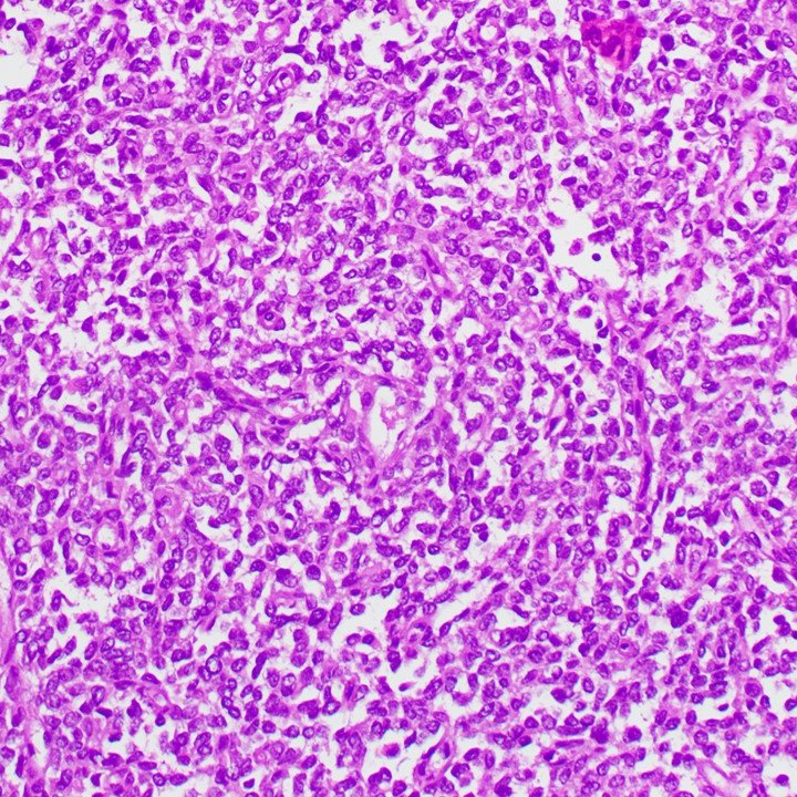 UTHoustonPath's tweet photo. Meningeal lesion in an 80 yo M. Diagnosis? 🧠🔬#neuropath #PathX #PathTwitter https://t.co/0XCV0dYm6f