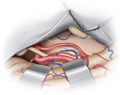 Extension of the tentorial incision up to the Meckel’s cave allow anterolateral reflection of the medial tentorial flap. If the incision extends to the most lateral aspect of the Meckel’s cave, which structures can be visualized?  

#Neurosurgery #CranialBaseSurgery