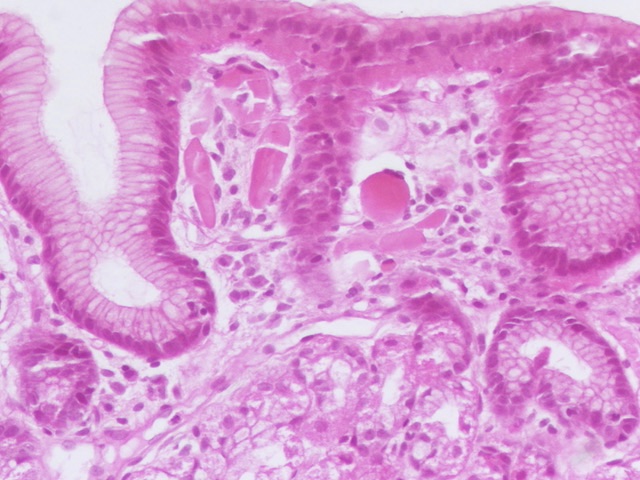 Celina Stayerman MD (@ariella8) on Twitter photo Dear #GIPath Routine gastric bx ,do you know what these eosinophilic structures are ?
I think I saw once here in twitter that can be amyloid like that and a special name to this ??
I think this is called globular amyloidosis ,but have to prove it .
<a href="/RaulSGonzalezMD/">Raul S. Gonzalez, MD</a> Dear #GIPath Routine gastric bx ,do you know what these eosinophilic structures are ?
I think I saw once here in twitter that can be amyloid like that and a special name to this ??
I think this is called globular amyloidosis ,but have to prove it .
<a href="/RaulSGonzalezMD/">Raul S. Gonzalez, MD</a>
