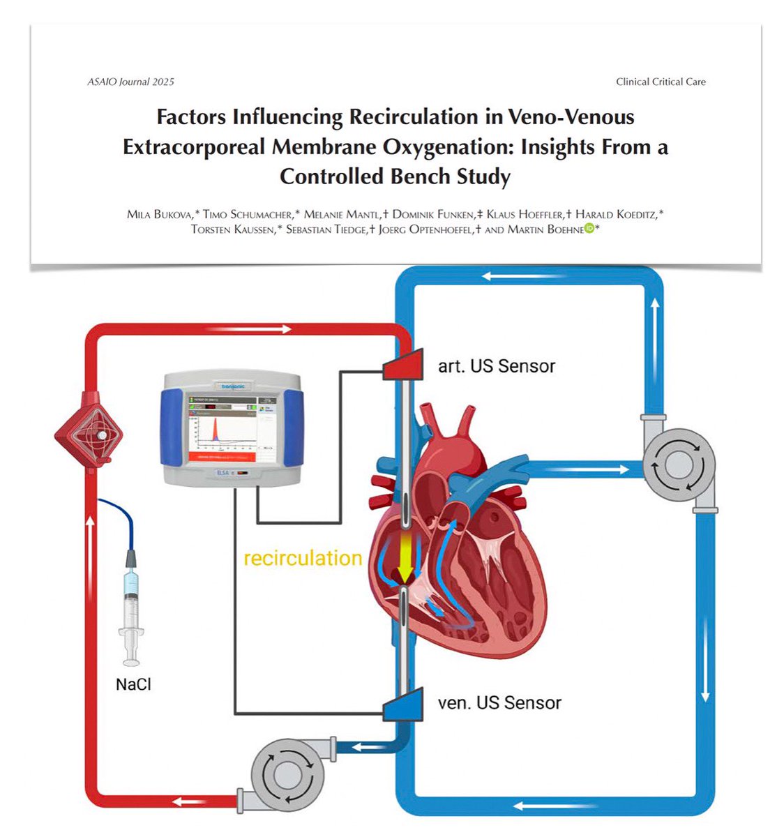 Recirculation in VV #ECMO:
⚗️🐖 Several single (SLC) + dual lumen cannula (DLC) configurations, positions, EBF, CO, CVP assessed for impact 
📏 with SLC, cannula size or retraction beyond threshold distance had minimal
📏 with DLC exact positioning crucial, as suboptimal