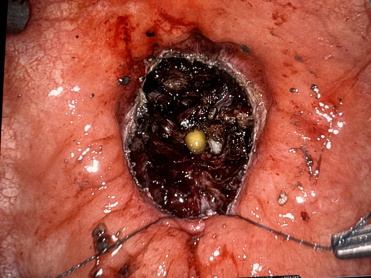 md_eun's tweet photo. Really proud of my team for publishing this on the transvesical approach to bladder neck reconstruction. We developed this after hundreds of transvesical simple prostatectomy w/360 anastomosis. With this experience under our belt, it was a natural next step to do BNR. Congrats!!! https://t.co/fvMSFdNnit