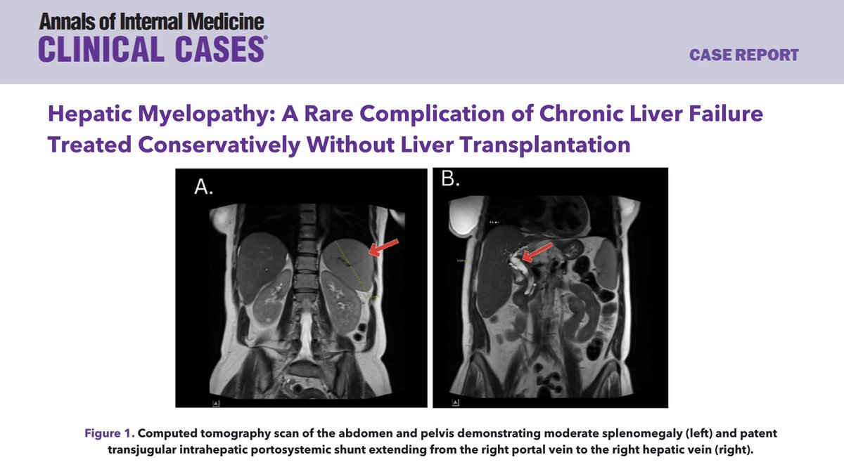 Read this case of hepatic myelopathy, a rare complication of chronic liver failure, treated without transplantation. Supplemental video shows the patient during initial exam before treatment with hyperreflexia of the patellar reflex, upward going Babinski, fasciculations of the
