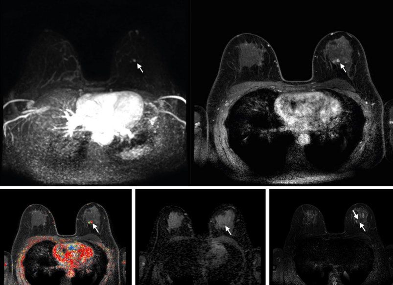 AuntMinnie.com (@auntminnie) on Twitter photo Abbreviated MRI suffices in imaging dense breasts #radiology #MRI #breastcancer <a href="/UMCU_Intl/">UMC Utrecht International</a> buff.ly/4Lj71d4 Abbreviated MRI suffices in imaging dense breasts #radiology #MRI #breastcancer <a href="/UMCU_Intl/">UMC Utrecht International</a> buff.ly/4Lj71d4
