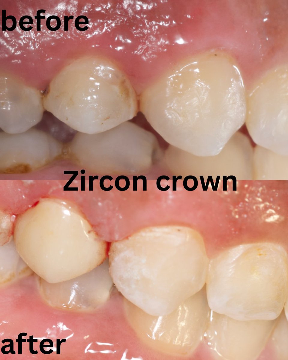 Endo treated tooth came for full coverage zircon crown