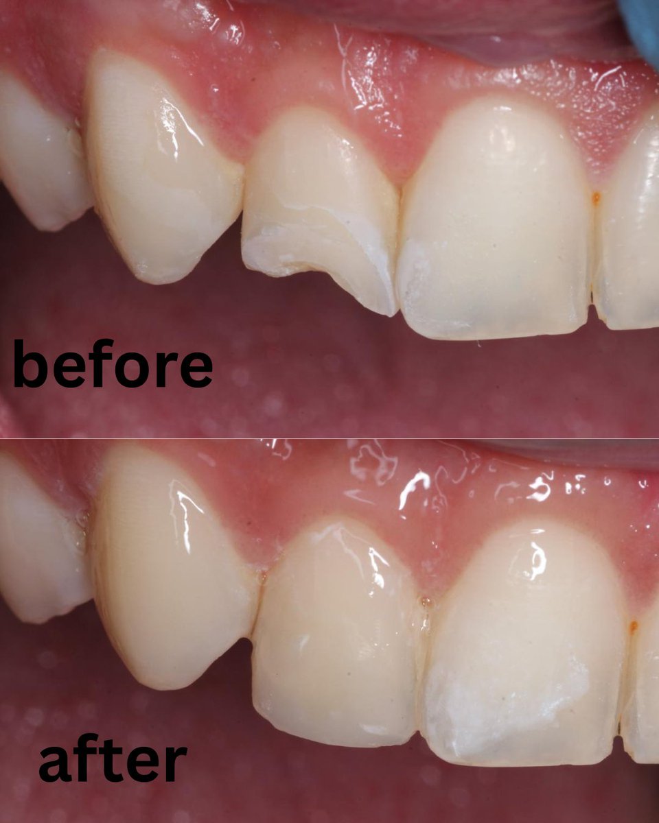 مريض بعمر ٢٢ سنه يشكي " سويت سني من زمان و طاحت الحشوه " 
Composite restoration was enough